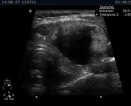 Ultrasonido de Tiroides | Clínica de Ultrasonido en Cancún
