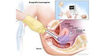 Ultrasonido Endovaginal