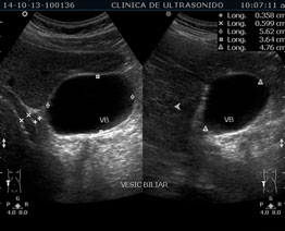 Ultrasonido Renal, Vesical, Vesicoprostático | Clínica de Ultrasonido en Cancún