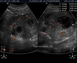 Ultrasonido Renal, Vesical, Vesicoprostático | Clínica de Ultrasonido en Cancún